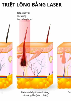 Triệt lông SHR là gì? Ưu nhược điểm của triệt lông SHR