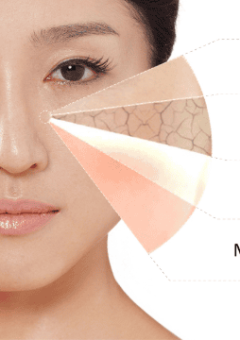 Khi triệt lông cho da nhạy cảm cần lưu ý những gì?