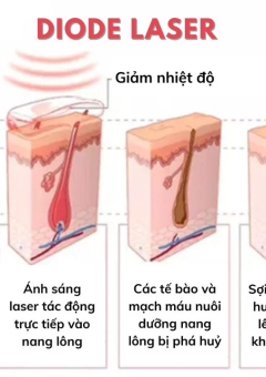 Công nghệ triệt lông diode laser? Có khác gì với những công nghệ khác