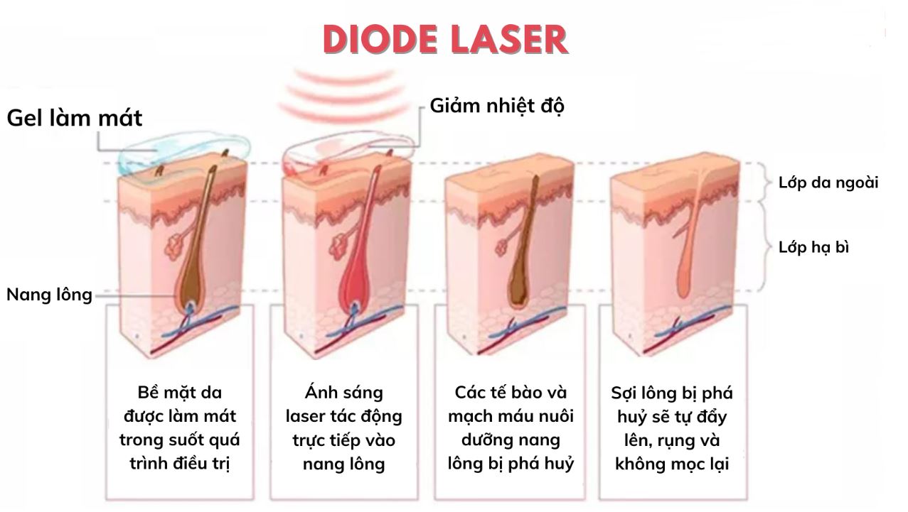 Công nghệ triệt lông diode laser